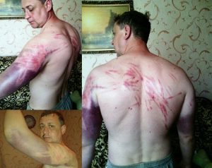Pastor Sergey Kosyak after being tortured by mercenaries in the Russia-occupied territory of Donbas.