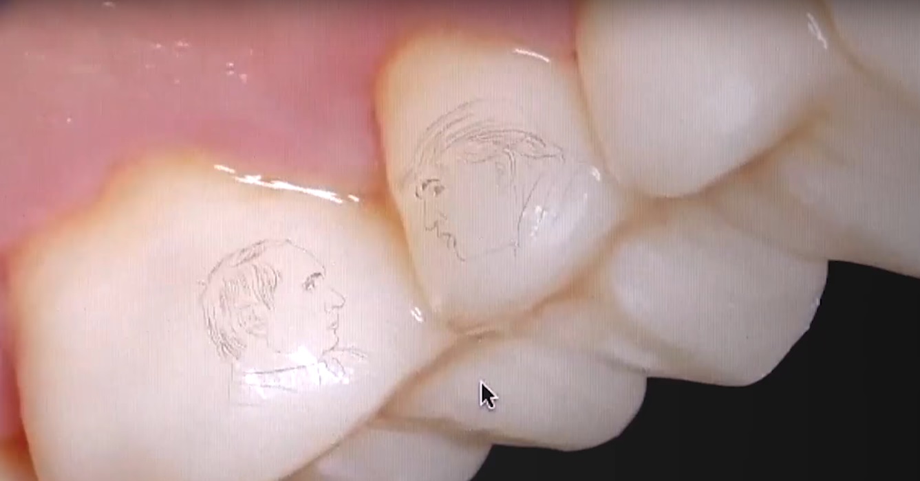 A resident of Sochi resident in Russia had profiles of Trump and Putin engraved on his teeth (Image: video capture)
