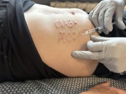 A Russian surgeon carved "Glory to Russia" inscription on a body of Ukrainian soldier who was captured over 15 months ago. After his return to Ukraine, the soldier is undergoing treatment to remove the tattoo.