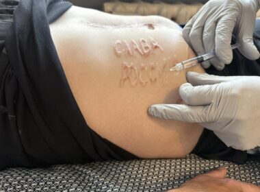 A Russian surgeon carved "Glory to Russia" inscription on a body of Ukrainian soldier who was captured over 15 months ago. After his return to Ukraine, the soldier is undergoing treatment to remove the tattoo.