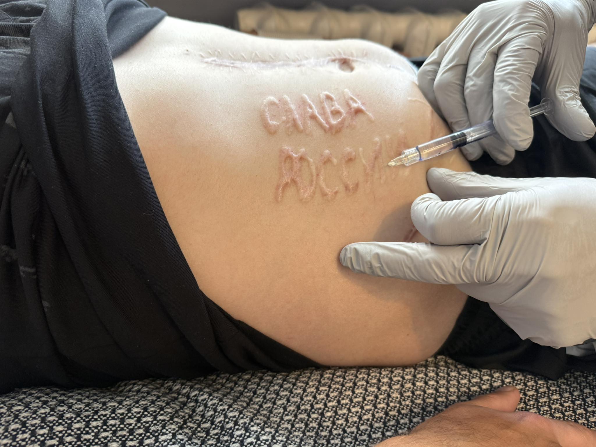 A Russian surgeon carved "Glory to Russia" inscription on a body of Ukrainian soldier who was captured over 15 months ago. After his return to Ukraine, the soldier is undergoing treatment to remove the tattoo.