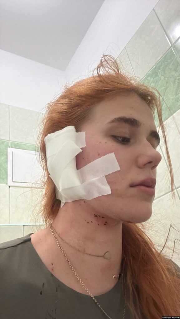 couple beaten being ukrainians—the latest case poland's rising anti-ukrainian violence · post nastia ukrainian woman injured wrocław attack neck stitched face bandaged 26 2026 українка після нападу у вроцлаві липня