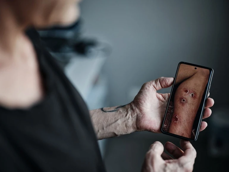 A Ukrainian defender who returned from Russian captivity shows the effects of his detention. June 2023